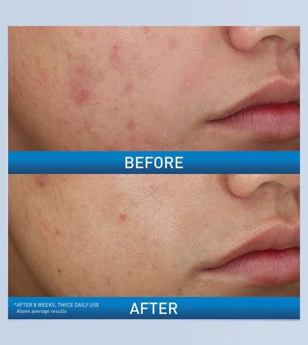CeraVe Acne Foaming Cream Cleanser 10% (150ml) - Image 7